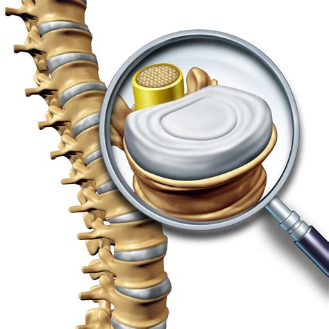 Lumbar Discograms Greater Houston Interventional Pain