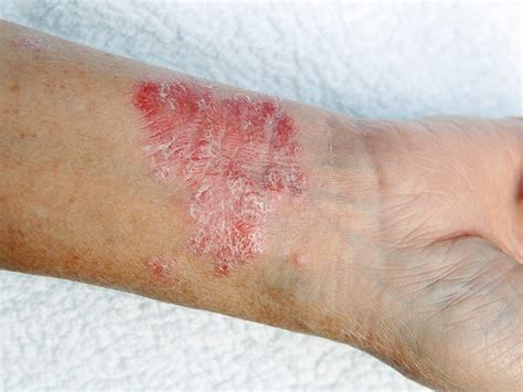 Red Circle On The Skin But Not Ringworm Other Causes Medical News Today
