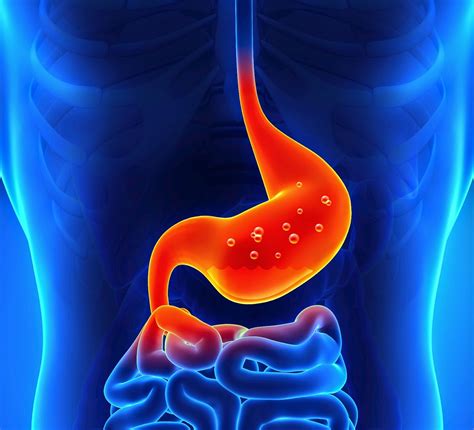أسباب حرقان المعدة المستمر