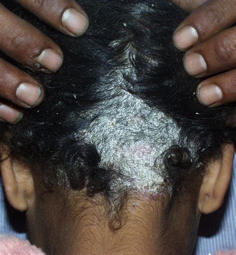 Fungal Infections Of The Skin Tinea Capitis And Tinea Versicolor And