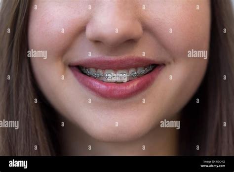 Teenage Girl Braces Hi Res Stock Photography And Images Alamy
