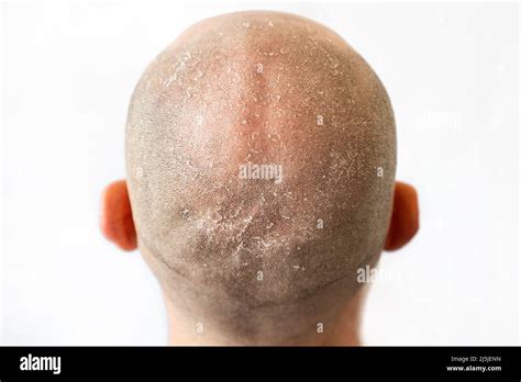 Male Bald Flaky Head With Dandruff Close Up Back View White