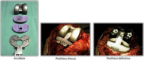 Vidéo montrant le déroulement de la pose d'une prothèse de genou. Prothèse Totale de Genou - Chirurgie-toulouse.fr