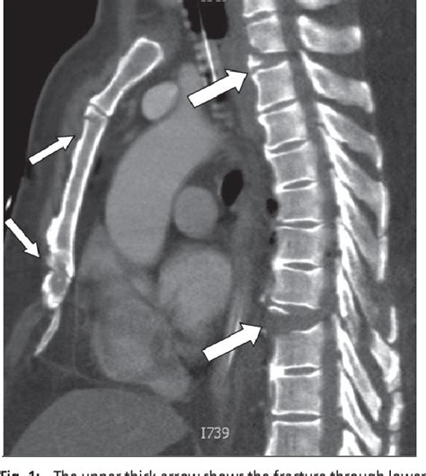 Figure 1 From Double Level Extension Distraction Thoracic Spine