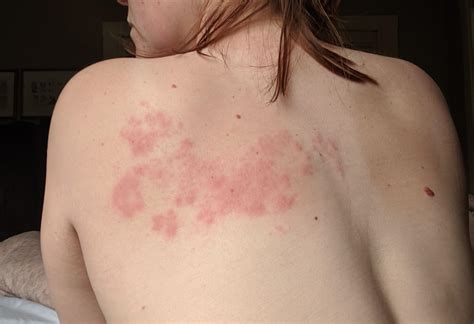 Images Of Shingles Rash On Chest The Most Common First Signs Of