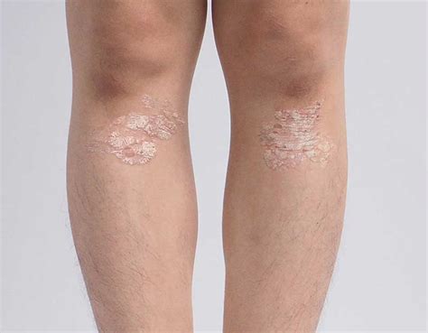 Pediatric Psoriasis Before And After Results Taltz® Ixekizumab