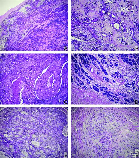 A Pleomorphic Adenoma Hande 100x Tumor Composed Of Epithelial And