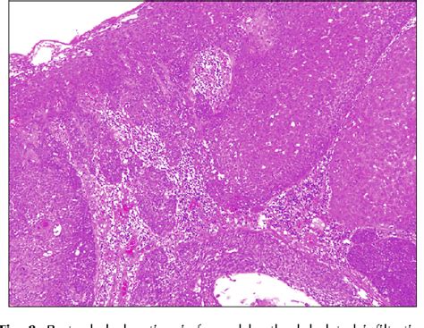 Figure 2 From A Case Of Eccrine Porocarcinoma Usefulness Of