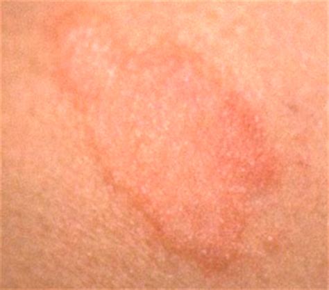 Unexplained itching all over the body can also be caused by kidney disease or scabies. Itchy, Red Rash All Over Body