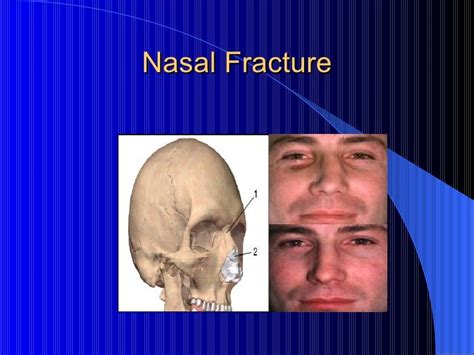 Treatment Of Nasal Fracture By Paul Of Aegina
