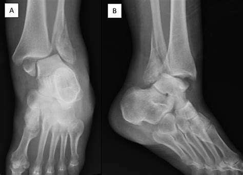 Cureus Rotational Ankle Fracture Dislocation With Associated Lisfranc