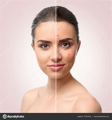 Woman Face Before And After Acne Treatment Procedure Skin Care Concept