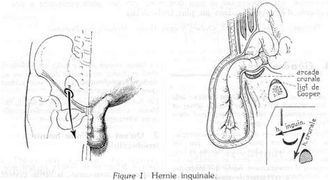 La hernie discale apparaît lorsqu'un des disques intervertébraux sont endommagés. Développement et Santé | Hernie étranglée