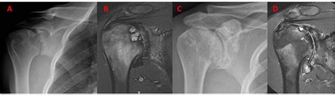 Diagnosis And Treatment Of Avascular Necrosis Of The Humeral Head