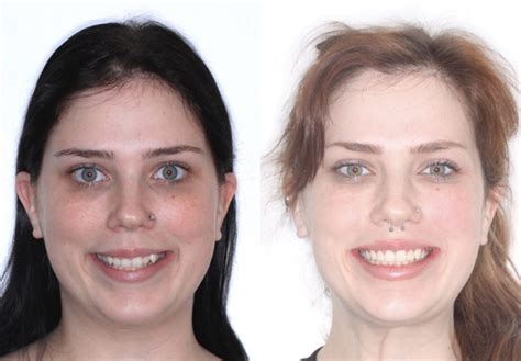 Tad Non Surgical Gummy Smile Correction Bloom Orthodontics Long