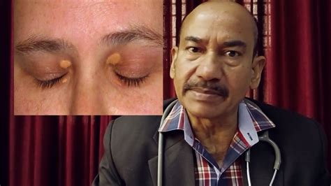 Xanthelasma Causes Risk Factors And Homoeopathic Treatment Dr Rs