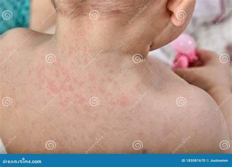 Roseola Rash A Viral Rash On The Skin Of A Child Stock Photo Image Of