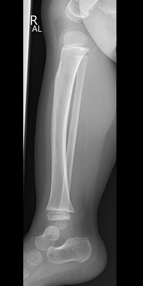Toddler S Fracture
