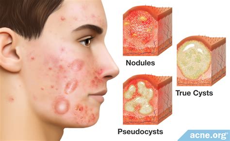Cystic Acne On Chin Treatment Of Cystic Acne Cystic Acne On Chin