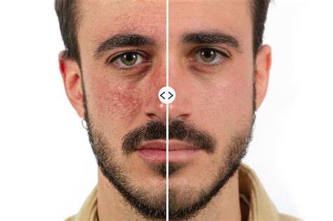Premium Photo Man Face With Red Skin Rosacea Before And After