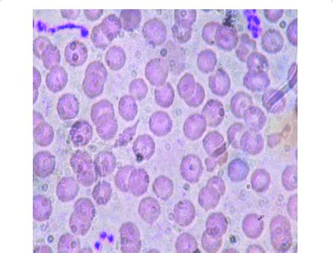 The Peripheral Blood Smear Is Mostly Normocytic Normochromic With Few