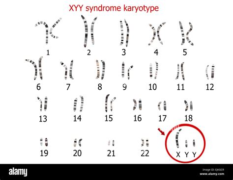 Xyy Syndrome Supermale Karyotype Stock Photo Alamy