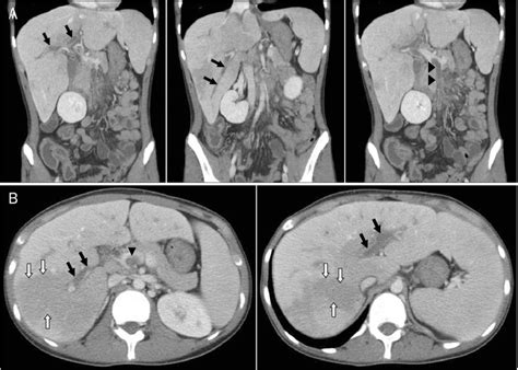 Contrast Enhanced Abdominal Computed Tomography Findings Multiple