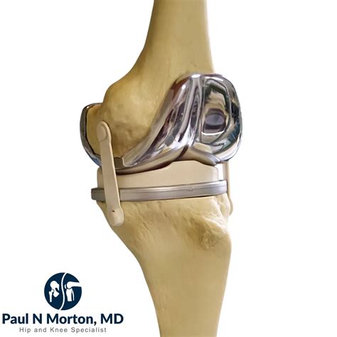 Durability Of Knee Replacement Implants Dr Paul Norio Morton Md