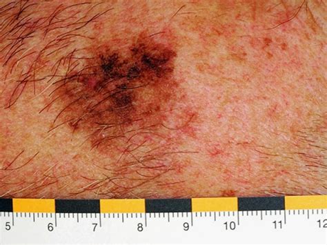 New Test Ids Early Stage Melanoma With Metastatic Risk