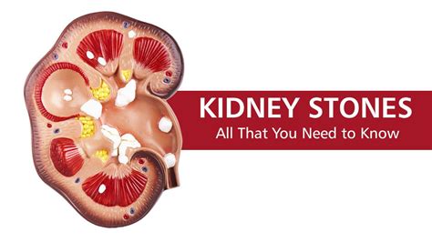 Kidney Stones Risk Factors Symptoms And Treatment Kidney Stones