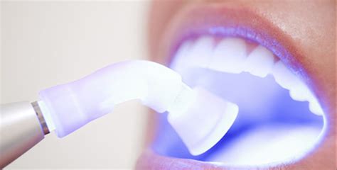 Laser Teeth Whiting Dentist In Chandigarh The Smile Designerst