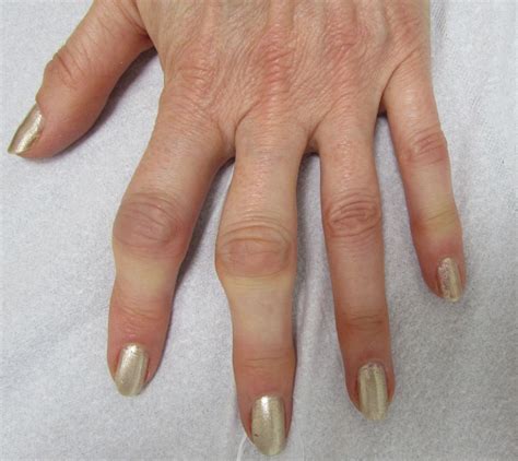 Artrosis De Mano Dolor De Dedos Y Debilidad Como Mejorarla