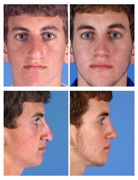 Male Rhinoplasty Before And After Photos