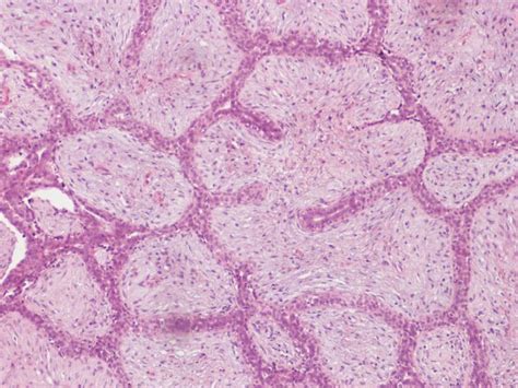 Benign Phyllodes Tumors Histology Note The Difference Between