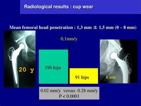 Ppt Charnley Kerboull Total Hip Replacement Long Term Results In