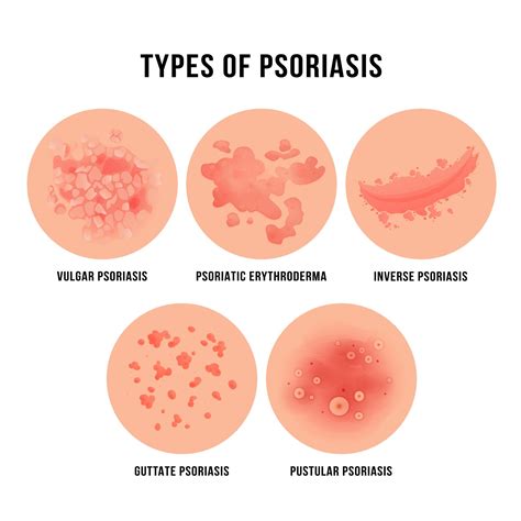 Psoriasis Understanding The Condition And Treatment Options