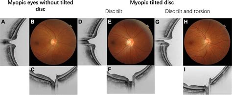 Frontiers Myopic Tilted Disc Mechanism Clinical Significance And