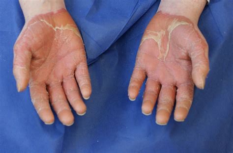 Pityriasis rubra pilaris (prp) is a rare skin disorder that causes inflammation of the skin, thickening of the nails and at times shedding of the hair. Pityriasis rubra pilaris: a rare inflammatory dermatosis ...