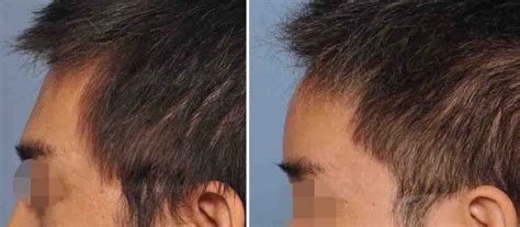 Plastic Surgery Case Study Asian Male Bone Cement Forehead