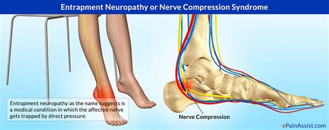 Nerve Compression Syndromes Entrapment Neuropathies Nerve Entrapments