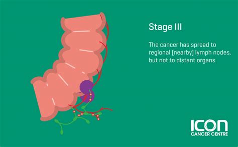 Colorectal Cancer Signs And Symtomps Icon Centre Singapore