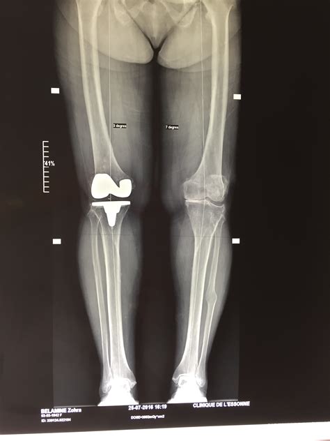 3 ans après, descellement tibial de la prothèse et décision de changement de prothèse. prothese de genou - PTG ou PUC - Chirurgie genoux Evry