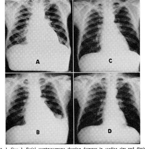 Figure 1 From Clinical Progress Beriberi Heart Disease By Reverdy