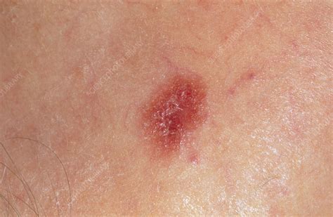 Amelanotic Malignant Melanoma Skin Cancer Stock Image M1310297