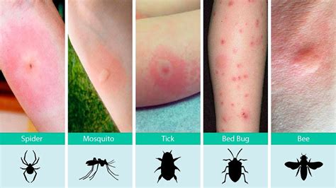 If you spend time outdoors, you'll probably have to deal with bug bites from time to time. Ouch, What Bit Me? How to Identify Common Bug Bites and