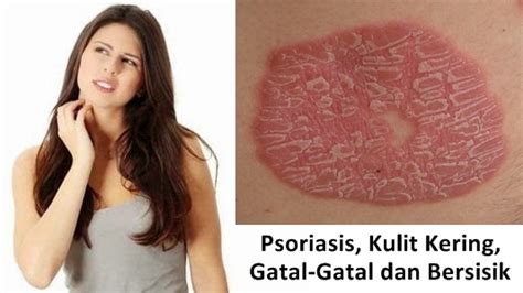 Cara Mengobati Psoriasis Secara Alami Pengobatan Penyakit Kulit Alami