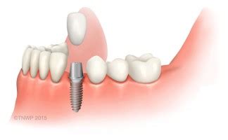 Single Dental Implant One Missing Tooth Teeth Implants Comfort