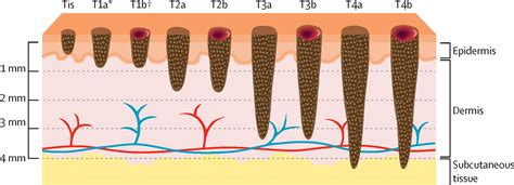 Cutaneous Melanoma The Lancet