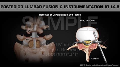 Posterior Lumbar Fusion And Instrumentation At L4 5 Youtube