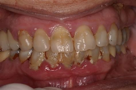 The Importance Of Periodontal Treatment In Postcovid 19 Dentistry